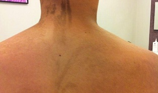 Linear and whorled nevoid hypermelanosis